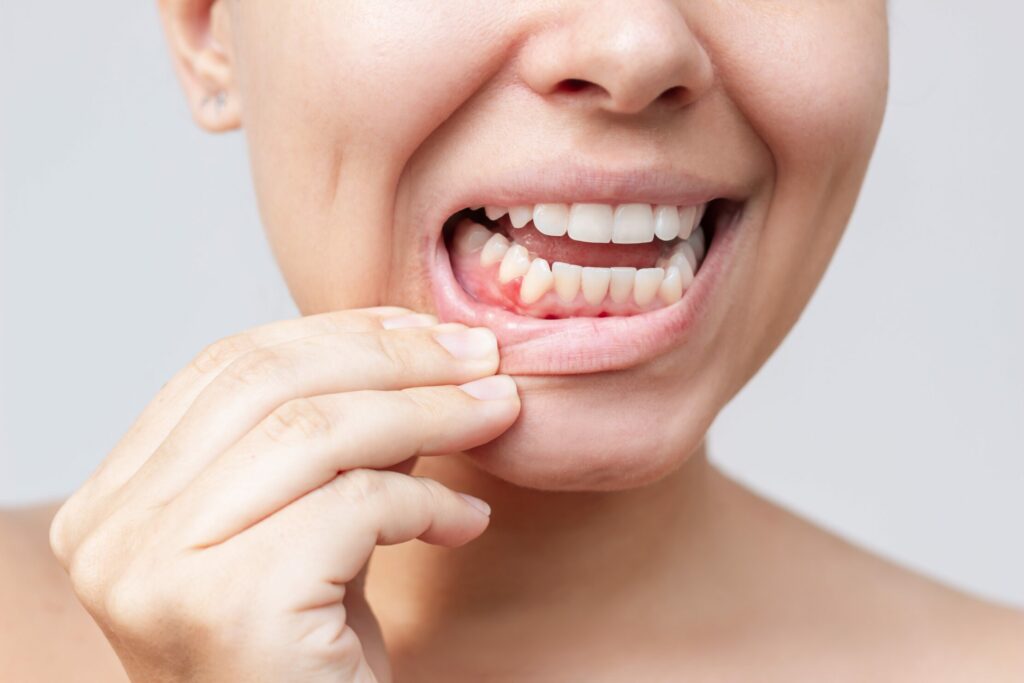 Understanding Periodontal Disease and How to Treat It