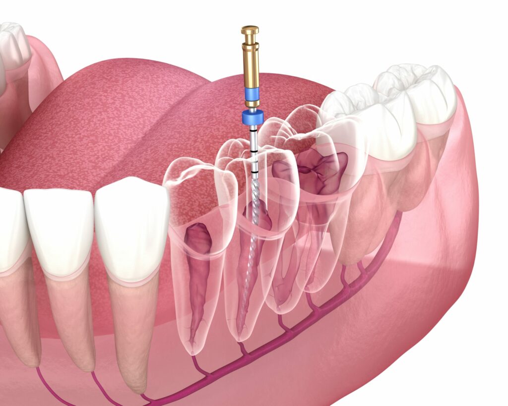 Modern Root Canal Therapy: Saving Your Tooth Comfortably
